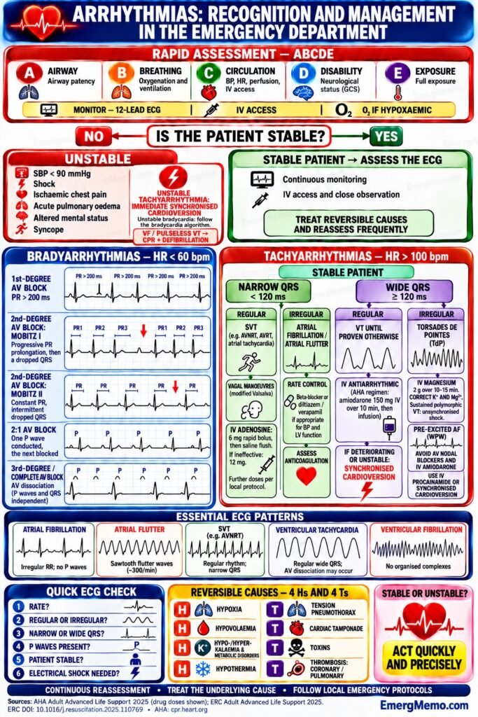 Arrhythmias: Recognition and Management in the Emergency Department English EmergMemo infographic on emergency assessment of arrhythmias, AV blocks and tachyarrhythmias. Read the accompanying clinical notes.